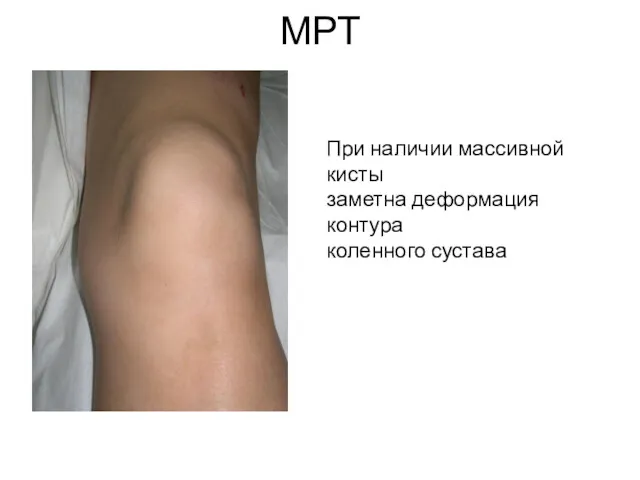 МРТ При наличии массивной кисты заметна деформация контура коленного сустава