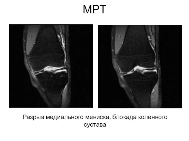 МРТ Разрыв медиального мениска, блокада коленного сустава