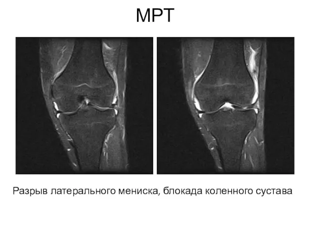 МРТ Разрыв латерального мениска, блокада коленного сустава