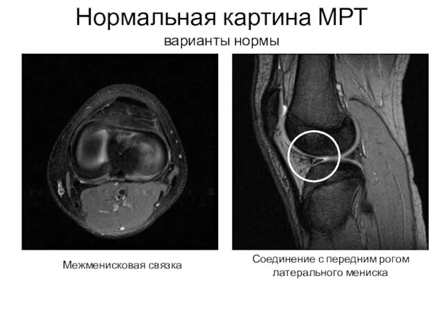 Нормальная картина МРТ варианты нормы Межменисковая связка Соединение с передним рогом латерального мениска