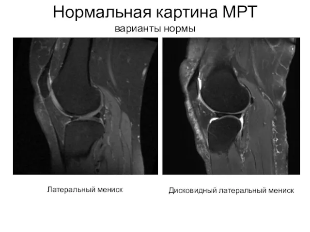 Нормальная картина МРТ варианты нормы Латеральный мениск Дисковидный латеральный мениск