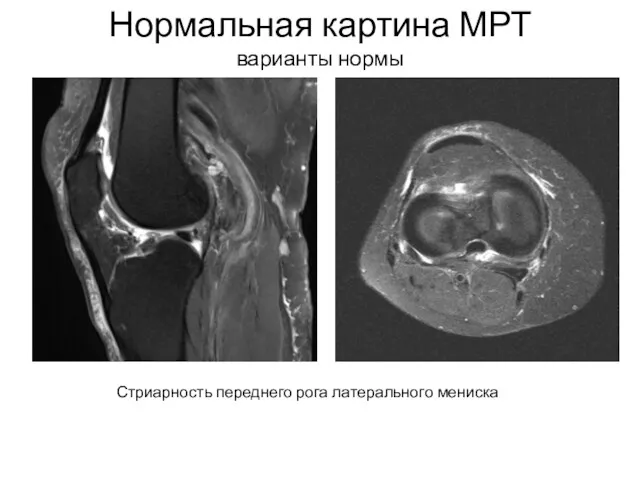 Нормальная картина МРТ варианты нормы Стриарность переднего рога латерального мениска