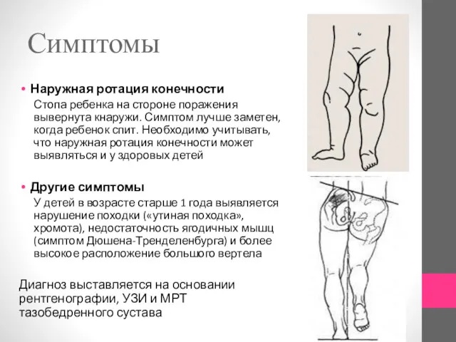 Симптомы Наружная ротация конечности Стопа ребенка на стороне поражения вывернута