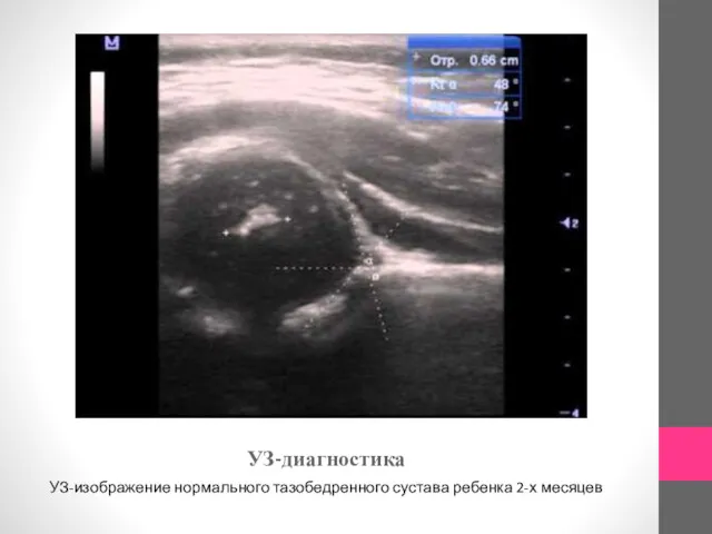 УЗ-диагностика УЗ-изображение нормального тазобедренного сустава ребенка 2-х месяцев