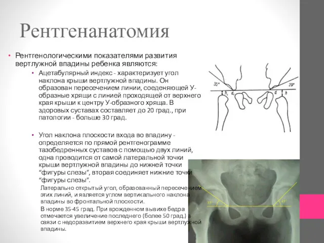 Рентгенанатомия Рентгенологическими показателями развития вертлужной впадины ребенка являются: Ацетабулярный индекс