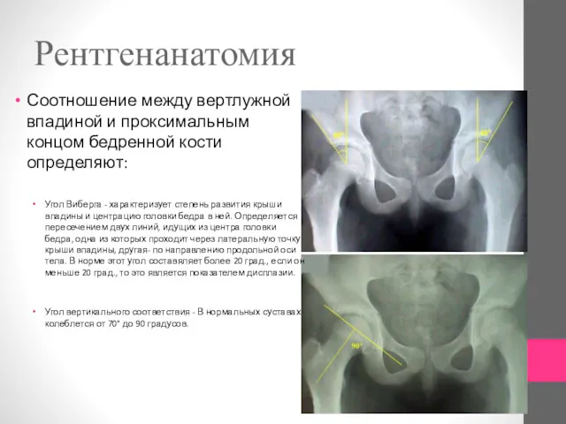 Рентгенанатомия Соотношение между вертлужной впадиной и проксимальным концом бедренной кости