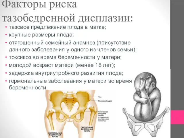 Факторы риска тазобедренной дисплазии: тазовое предлежание плода в матке; крупные