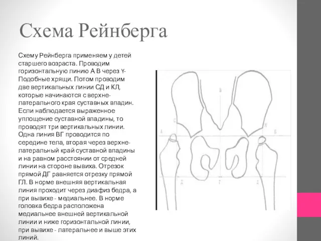 Схема Рейнберга Схему Рейнберга применяем у детей старшего возраста. Проводим