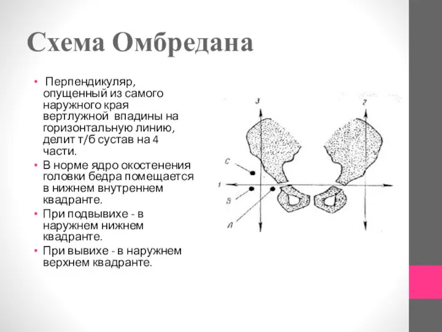 Схема Омбредана Перпендикуляр, опущенный из самого наружного края вертлужной впадины