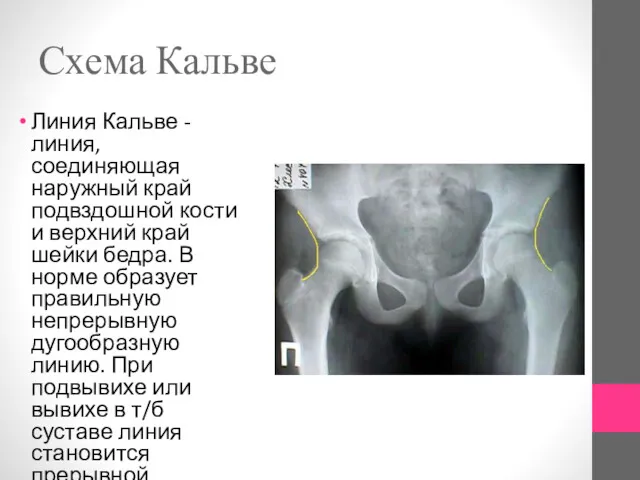 Схема Кальве Линия Кальве - линия, соединяющая наружный край подвздошной