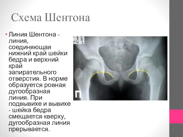 Схема Шентона Линия Шентона - линия, соединяющая нижний край шейки