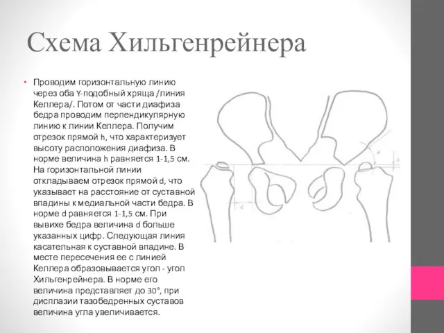 Схема Хильгенрейнера Проводим горизонтальную линию через оба Y-подобный хряща /линия