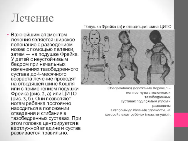 Лечение Важнейшим элементом лечения является широкое пеленание с разведением ножек