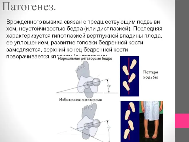 Патогенез. Врожденного вывиха связан с предшествующим подвыви­хом, неустойчивостью бедра (или