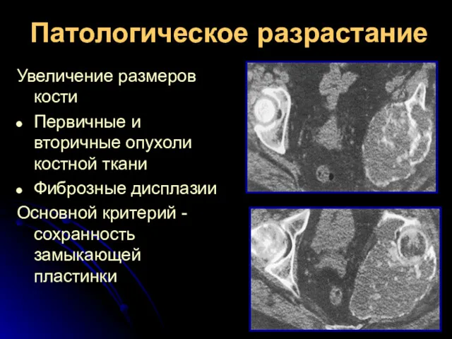 Патологическое разрастание Увеличение размеров кости Первичные и вторичные опухоли костной ткани Фиброзные дисплазии
