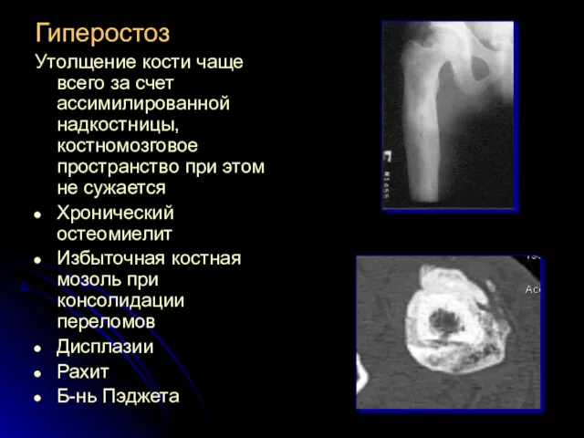 Гиперостоз Утолщение кости чаще всего за счет ассимилированной надкостницы, костномозговое пространство при этом