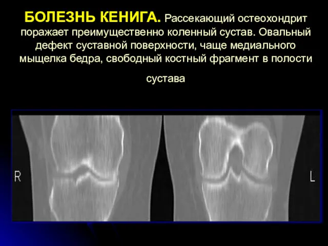 БОЛЕЗНЬ КЕНИГА. Рассекающий остеохондрит поражает преимущественно коленный сустав. Овальный дефект