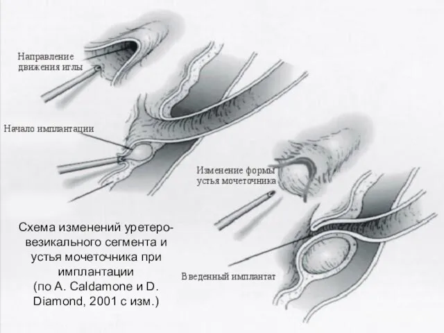 Схема изменений уретеро-везикального сегмента и устья мочеточника при имплантации (по