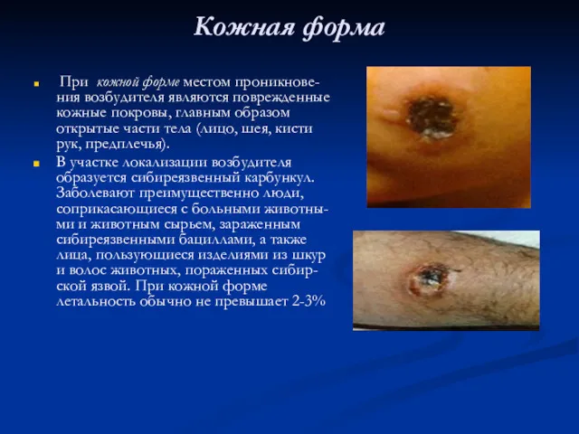 Кожная форма При кожной форме местом проникнове-ния возбудителя являются поврежденные