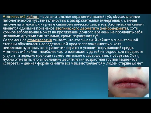 Атопический хейлит – воспалительное поражение тканей губ, обусловленное патологической чувствительностью