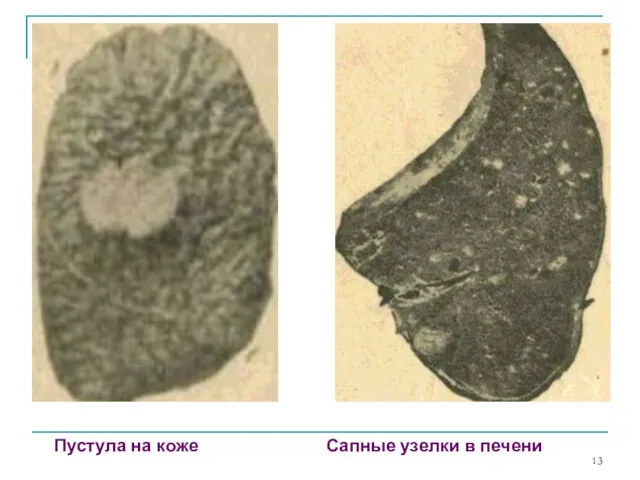 Пустула на коже Сапные узелки в печени