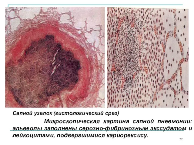 Сапной узелок (гистологический срез) Микроскопическая картина сапной пневмонии: альвеолы заполнены серозно-фибринозным экссудатом и лейкоцитами, подвергшимися кариорексису.