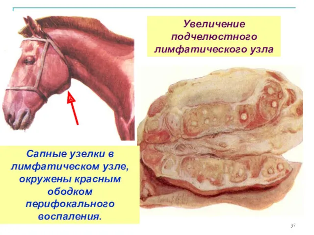 Увеличение подчелюстного лимфатического узла Сапные узелки в лимфатическом узле, окружены красным ободком перифокального воспаления.