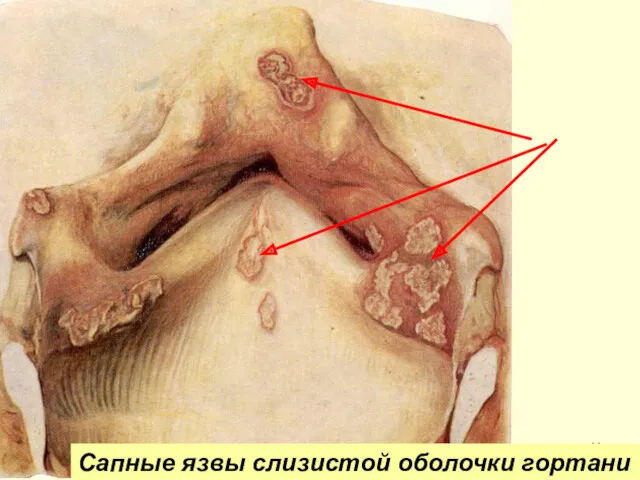 Сапные язвы слизистой оболочки гортани