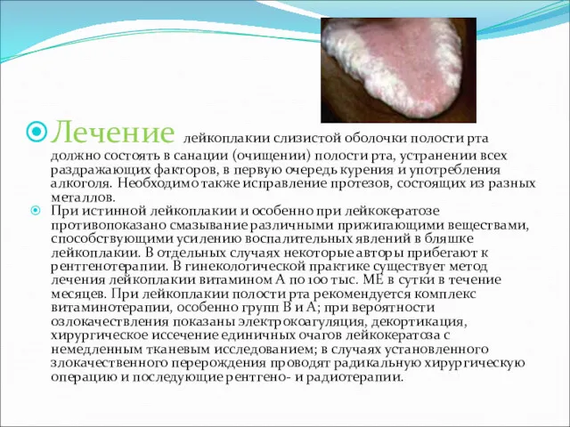 Лечение лейкоплакии слизистой оболочки полости рта должно состоять в санации