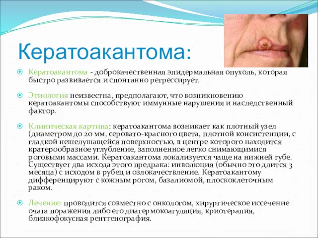 Кератоакантома: Кератоакантома - доброкачественная эпидермальная опухоль, которая быстро развивается и
