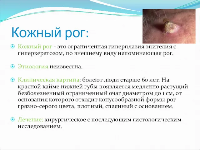 Кожный рог: Кожный рог - это ограниченная гиперплазия эпителия с