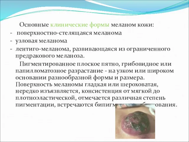 Основные клинические формы меланом кожи: - поверхностно-стелящаяся меланома - узловая
