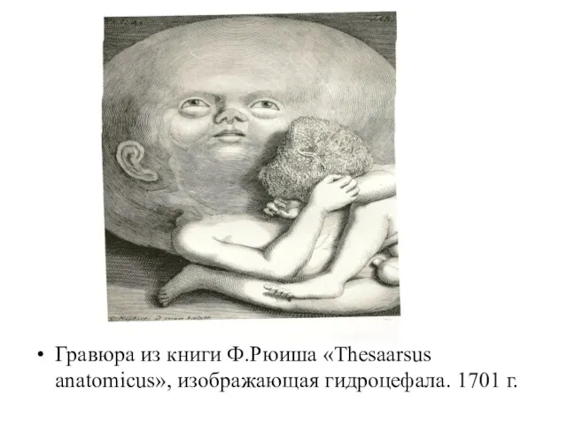 Гравюра из книги Ф.Рюиша «Thesaarsus anatomicus», изображающая гидроцефала. 1701 г.