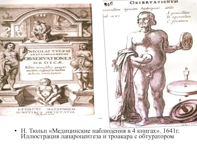 Н. Тюльп «Медицинские наблюдения в 4 книгах». 1641г. Иллюстрация лапароцентеза и троакара с обтуратором