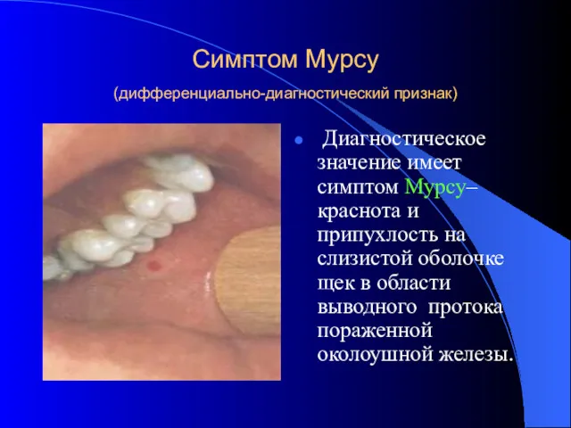 Симптом Мурсу (дифференциально-диагностический признак) Диагностическое значение имеет симптом Мурсу– краснота