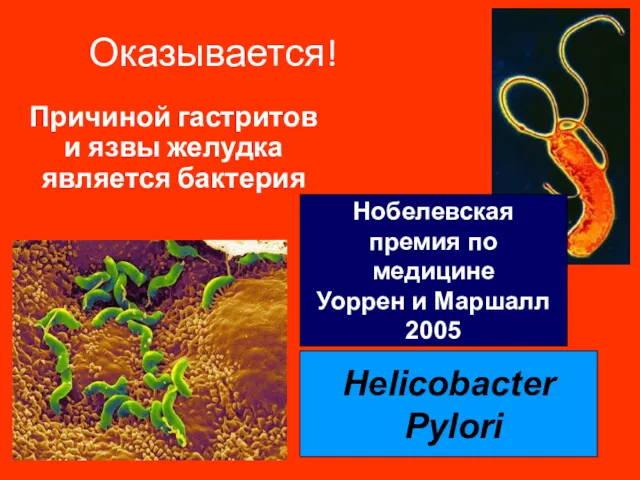 Оказывается! Причиной гастритов и язвы желудка является бактерия Helicobacter Pylori
