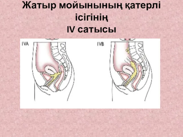 Жатыр мойынының қатерлі ісігінің IV сатысы