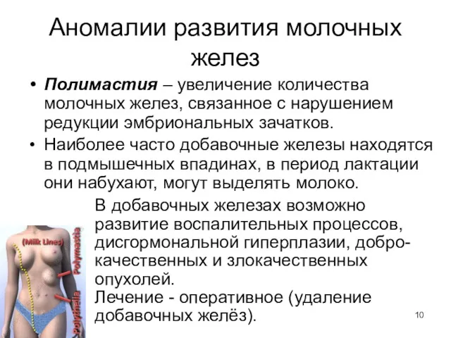 Аномалии развития молочных желез Полимастия – увеличение количества молочных желез, связанное с нарушением