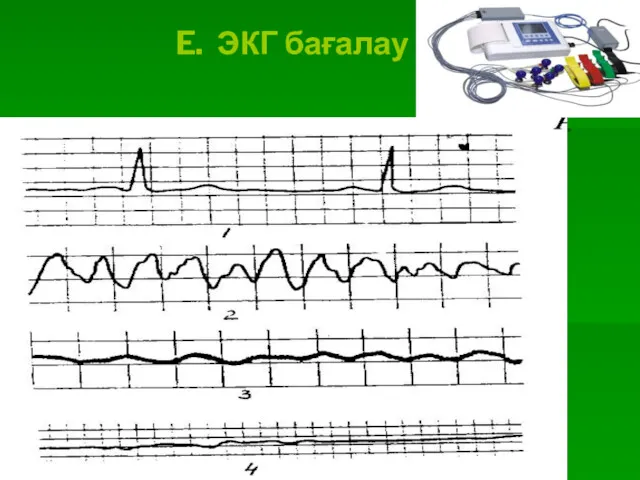 E. ЭКГ бағалау