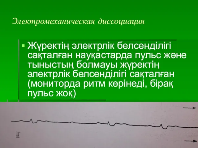 Электромеханическая диссоциация Жүректің электрлік белсенділігі сақталған науқастарда пульс және тыныстың