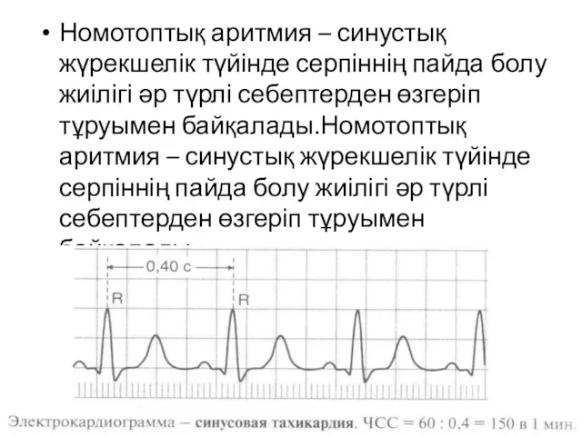 Номотоптық аритмия – синустық жүрекшелік түйінде серпіннің пайда болу жиілігі