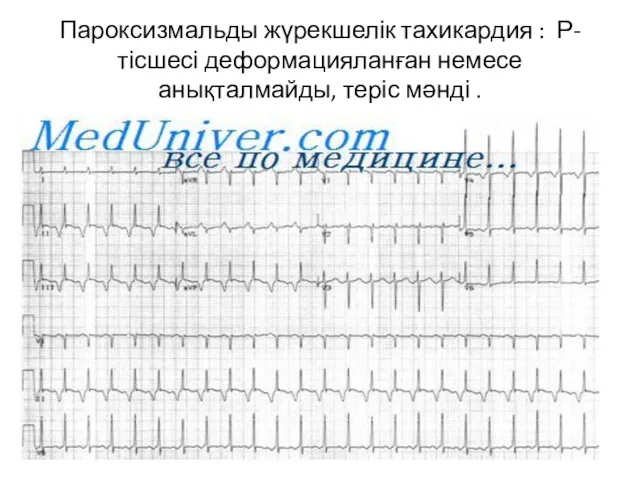 Пароксизмальды жүрекшелік тахикардия : Р-тісшесі деформацияланған немесе анықталмайды, теріс мәнді .