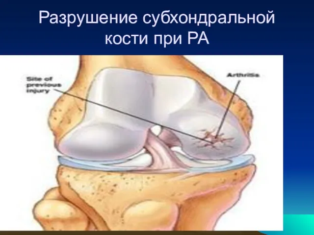 Разрушение субхондральной кости при РА