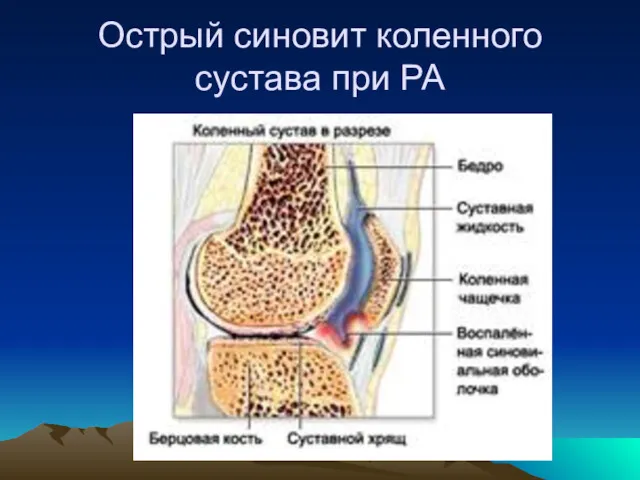 Острый синовит коленного сустава при РА