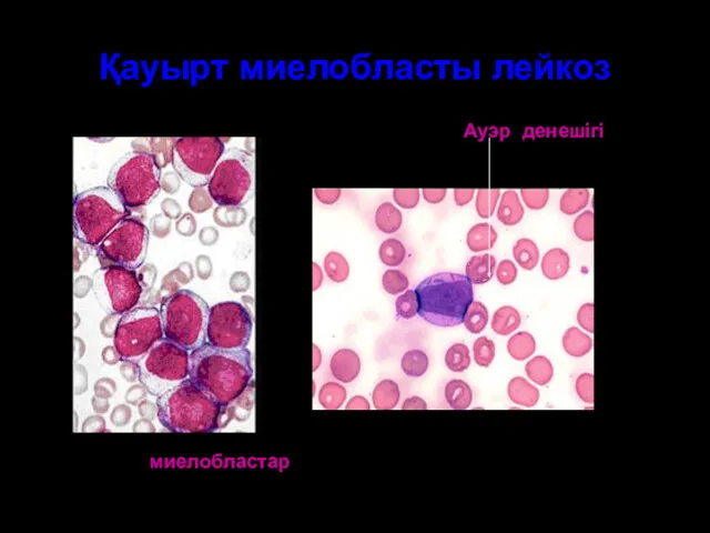 Қауырт миелобласты лейкоз Ауэр денешігі миелобластар