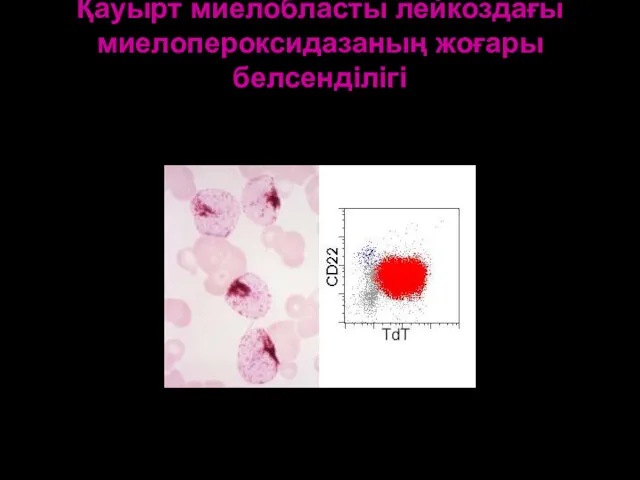 Қауырт миелобласты лейкоздағы миелопероксидазаның жоғары белсенділігі