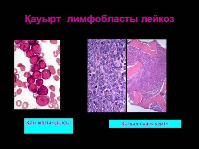 Қауырт лимфобласты лейкоз Қызыл сүйек кемігі Қан жағындысы