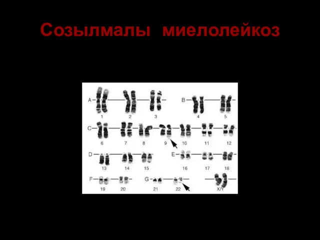 Созылмалы миелолейкоз