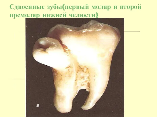 Сдвоенные зубы(первый моляр и второй премоляр нижней челюсти)
