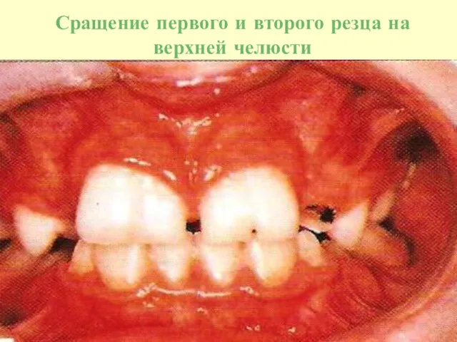Сращение первого и второго резца на верхней челюсти